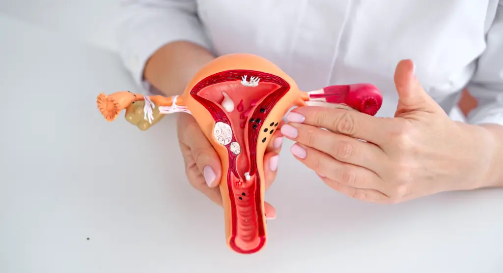 Banner Polycysteus ovariumsyndroom (PCOS)